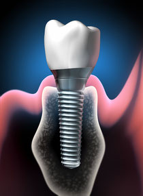 Implantologie Weiden Zahnimplantate: Schraubenförmige Wurzel im Kiefer mit Keramikkrone
