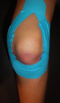 Knie- Taping bei Stauchung/Prellung