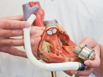Das Kunstherzsystem «Heartmate III» wurde weltweit zum ersten Mal implantiert. Foto: Julian Stratenschulte