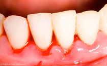 Blutendes Zahnfleisch kann ein erstes Anzeichen für Parodontose sein. (© Zsolt Bota Finna - Fotolia.com)