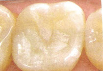     White Filling on Molar Tooth