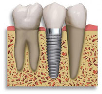 Dental Implant with Crown