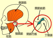 顎関節症による痛み