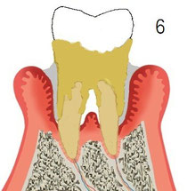 歯周炎後期