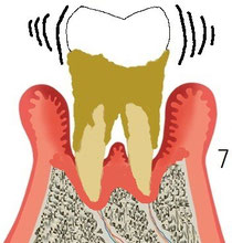 歯周炎末期