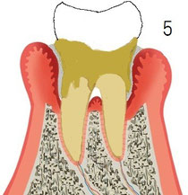 歯周炎中期