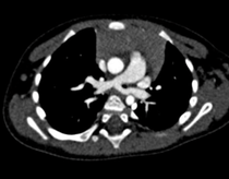 Coupe axiale de scanner thoracique. Visualisation d'une artère pulmonaire gauche naissant de l'artère pulmonaire droite et rejoignant le hile pulmonaire gauche par un trajet retro-trachéale.