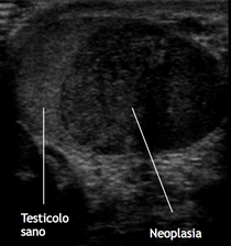 Visione ecografica di tumore testicolare