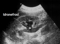 Immagine ecografica della dilatazione delle vie escretrici
