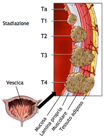 Papilloma vescicale maligno Papilloma vescicale benigno