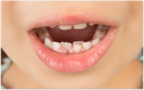 Wenn die bleibenden Zähne schon kommen, obwohl die Milchzähne noch da sind, sollten Sie einen Termin in der Zahnarztpraxis vereinbaren (© Mike D. - Fotolia.com)