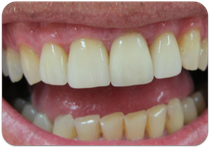Veneers der oberen vier Schneidezähne 12 Jahre nach dem Einsetzen (© Doc S)