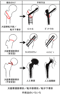大腿骨上部の骨折の違い