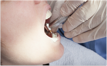 Professionelle Zahnreinigung beim Zahnarzt: Schutz vor Milchzahnkaries! (© patrisyu - Fotolia.com)