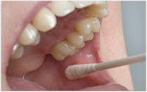 Speicheltest in der Zahnarztpraxis zur Bestimmung des Karies-Risikos (© proDente e.V.)