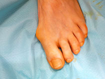 Hallux Valgus, Hammerzehe, vor OP