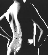 Neuromodulación raíces sacras