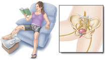 Neuromodulación tibial posterior