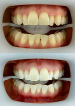 fläsh-Zahnbleaching-Zahnaufhellung-Weiße-Zähne-Zahnarztpraxis-Carina-Sell-Gießen