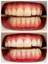 fläsh-Zahnbleaching-Zahnaufhellung-Weiße-Zähne-Zahnarztpraxis-Carina-Sell-Gießen