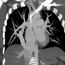 scanner en reconstruction MIP coronal: Syndrome de Cimeterre