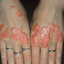 Psoriasis dos des mains 