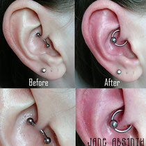 Ausbesserung einer falschen Platzierung des Daith Piercings. Klemmkugelring aus Titan in der Stärke 1,6mm eingesetzt.