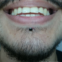 Labret Piercing mit dem Titanschmuck von NeoMetal USA.