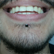 Labret Piercing mit dem Titanschmuck von NeoMetal USA.