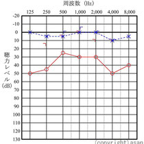 聴力検査で右（赤）が下がっています。