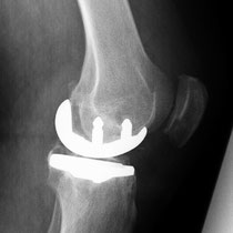 mediale Schlittenprothese seitlich