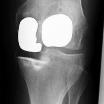 mediale Schlittenprothese mit Kniescheibenersatz