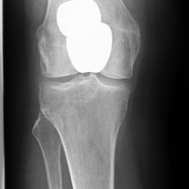 Nur Kniescheibenersatz