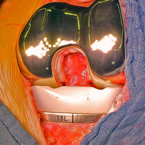 eingebautes Titanknie - e motion Fa. Aesulap