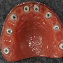 8 Keramik-Implantate im Oberkiefer, lingual