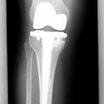Oberflächenersatz nach Wechseloperation mit Gender / Frauenkniekomponente