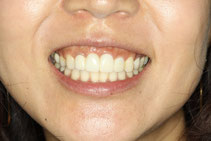 前歯の仮歯