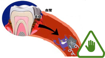 歯周病菌　むし歯菌　除菌治療