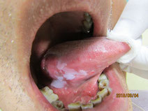 舌に生じた潰瘍、悪性が疑わしいケースはある程度診査したうえで専門機関へ紹介します