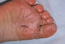photo de dermatose plantaire juvénile avec crevasses
