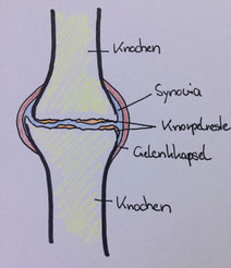 vereinfachte Darstellung eines arthrotischen Gelenkes