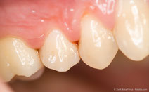 Entzündetes Zahnfleisch kann Folgen für Ihr Baby haben. (© Zsolt Bota Finna - Fotolia.com)