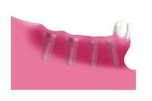 4 Implantate, die im Kieferknochen eingeheilt sind