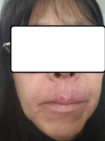 eczema autour de la bouche du au port des masques