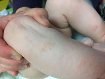 eczema sec tres etendu