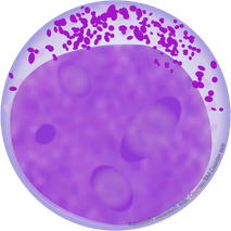 前骨髄球 Progranulocyte