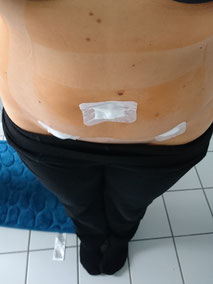 Bauch einer Frau nach der laparoskopischen Sterilisation, noch mit drei Pflastern