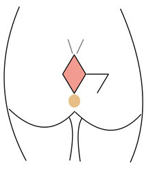 OP Limberg Steissbeinfistel (Sinus pilonidalis) -Sinus pilonidalis Zentrum Berlin