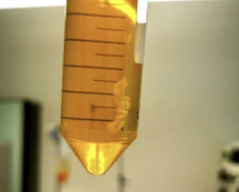 Inuspherese: Das Eluart zeigt einen Immunkomplex.