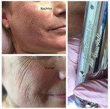 Luxus Plasma Liner - ohne op - Falten Behandlung - Pimp my Face - Hamburg Bramfeld